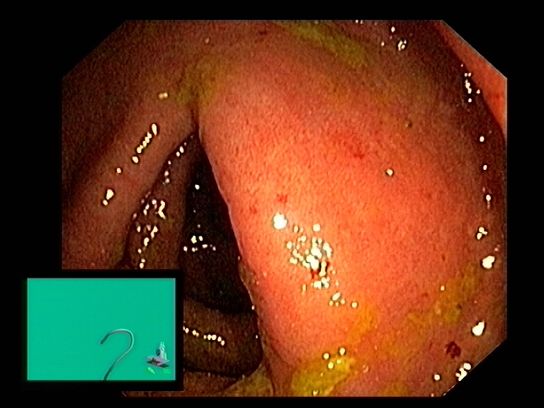 Эритематозная гастропатия