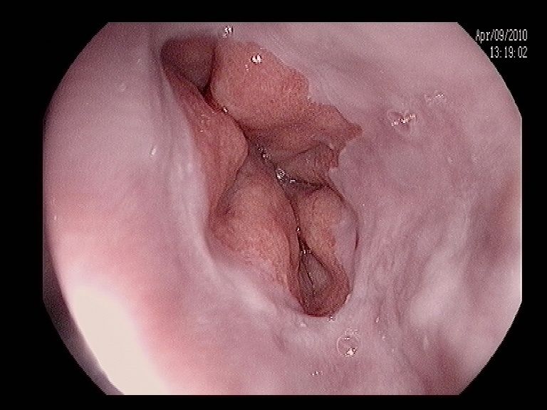 Варикозное расширение вен пищевода