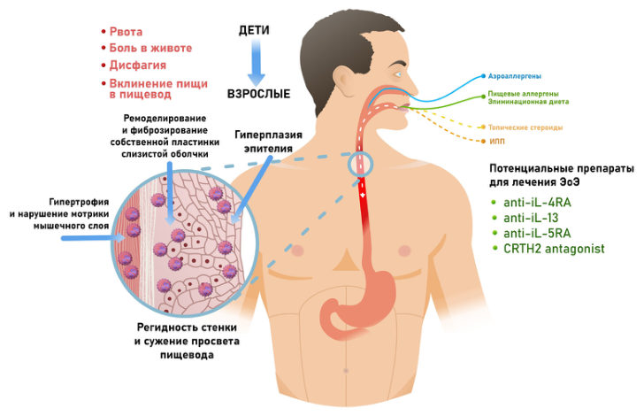 Рис. 4. Симптомы ЭоЭ у детей и взрослых [4].