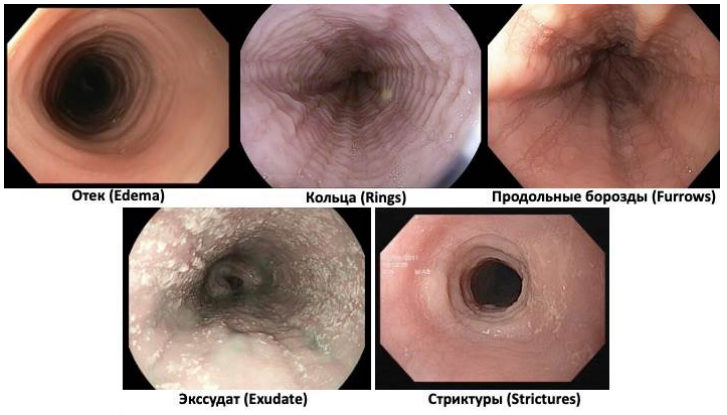 Рис. 5. Главные/основные эндоскопические признаки ЭоЭ.