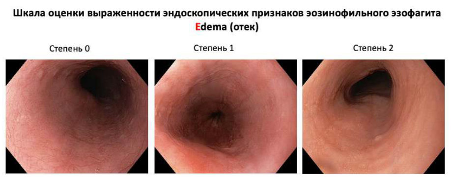 Шкала EREFS: Edema (отёк), степени 0–2