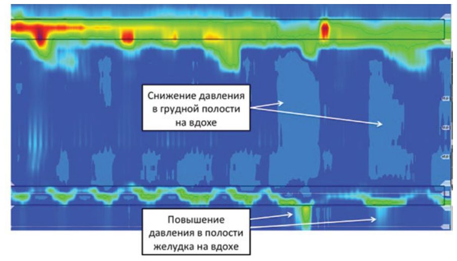 Проверка правильности расположения внутрипищеводного катетера перед началом исследования