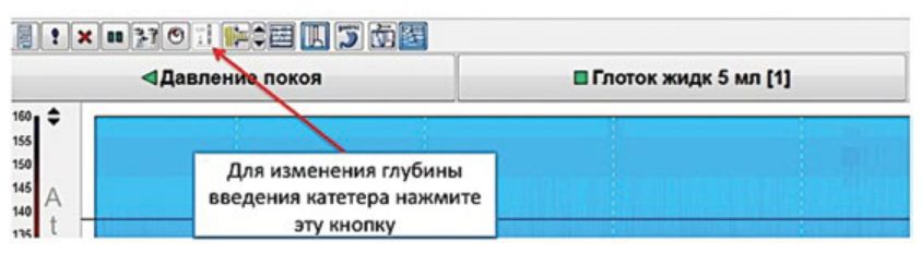 Изменение данных о глубине установки катетера