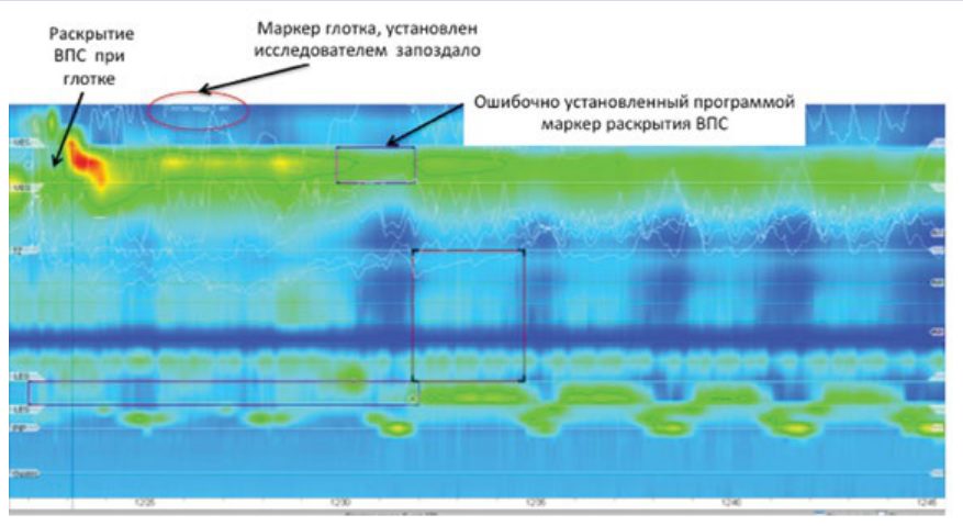 Неправильно выполненный и проанализированный глоток