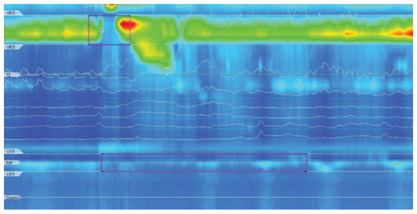 Отсутствие сократимости (absent contractility) в грудном отделе пищевода