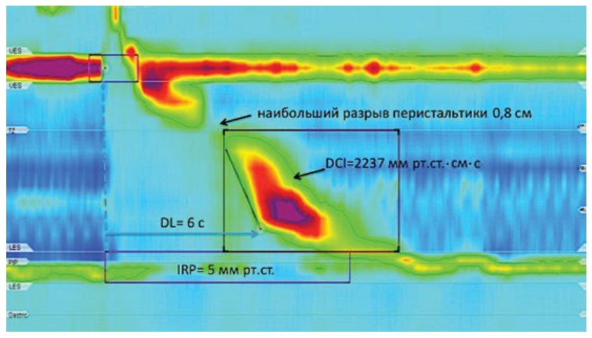 Нормальная моторика пищевода (normal esophageal motility)