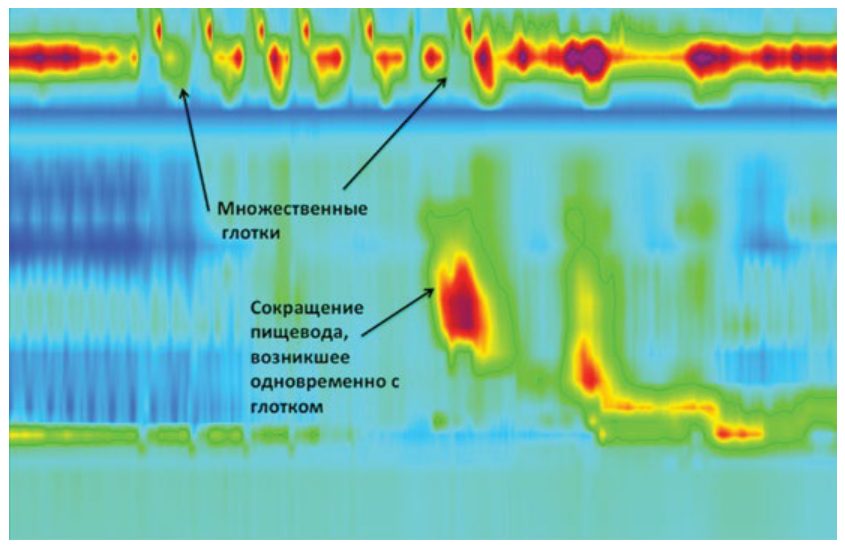 Тест с множественными быстрыми глотками: появление преждевременного сокращения